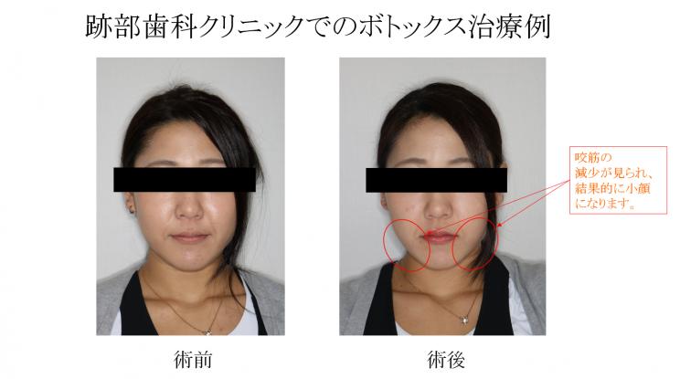 歯科でボトックス治療　ご存知ですか？