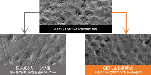 フッ素塗布